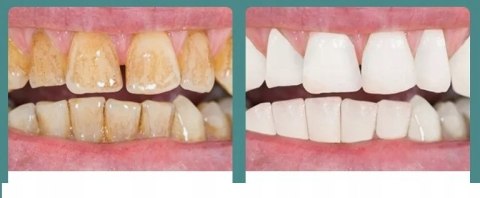 Ultradźwiękowy Skaler Dentystyczny - Precyzyjne Usuwanie Kamienia Nazębnego