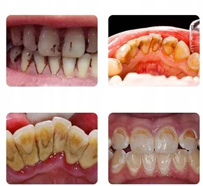 Ultradźwiękowy Skaler Dentystyczny - Precyzyjne Usuwanie Kamienia Nazębnego