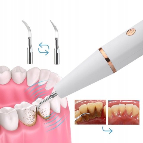 Ultradźwiękowy Skaler Dentystyczny - Precyzyjne Usuwanie Kamienia Nazębnego