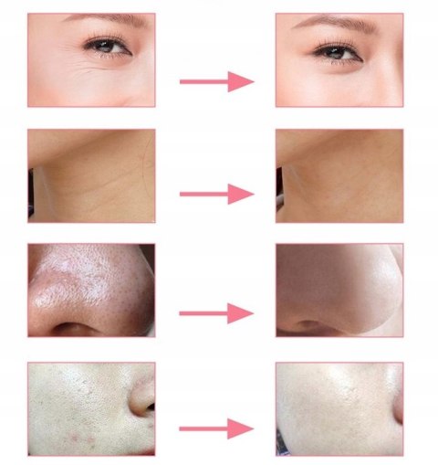 Urządzenie do Mikrodermabrazji Diamentowej Profesjonalne Oczyszczanie Skóry